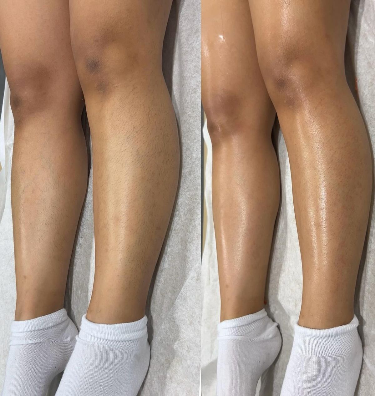 Drainage lymphatique — séquence jambes